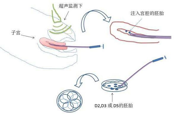 美国试管采用囊胚移植成功率高