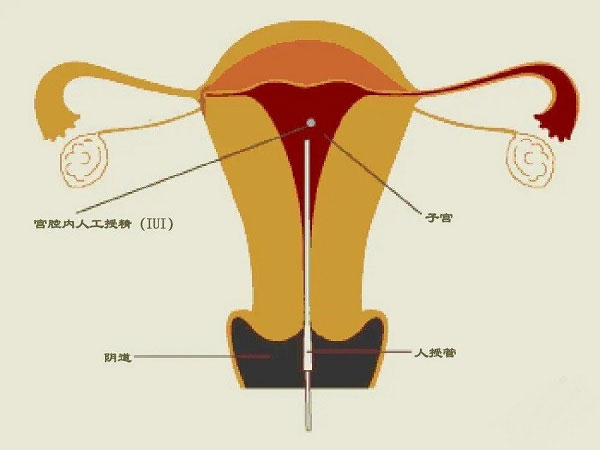 大多数医院都能够做人工授精