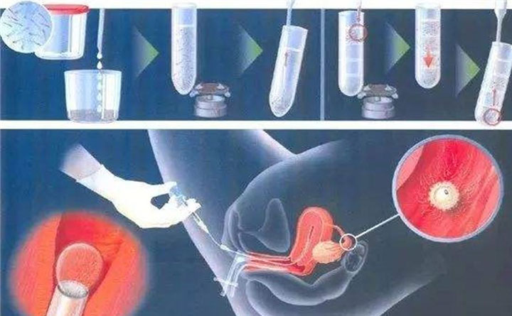 人工受孕技术